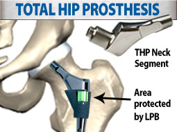 Total Hip Prosthesis Applicaiton Note