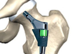 LPB Protected Hip Prosthesis LPB Protected Hip Prosthesis